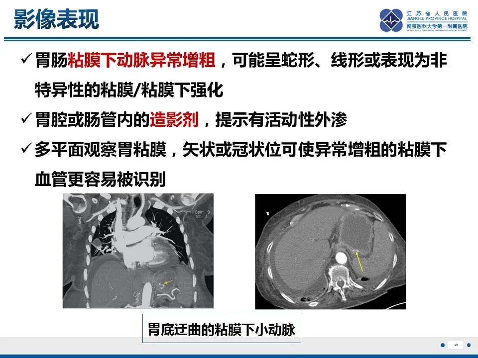 【PPT】胃恒径动脉综合征-30