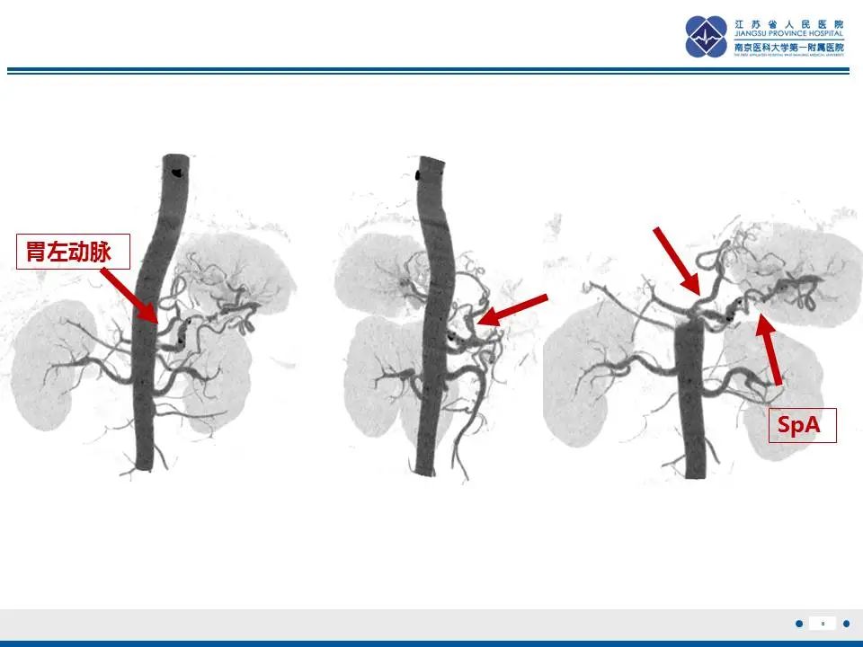 【PPT】胃恒径动脉综合征-9