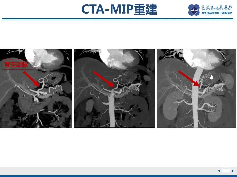【PPT】胃恒径动脉综合征-7