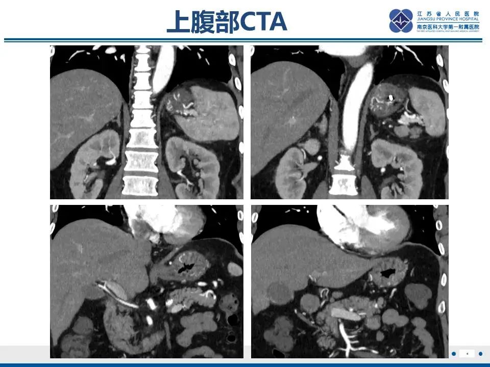 【PPT】胃恒径动脉综合征-5