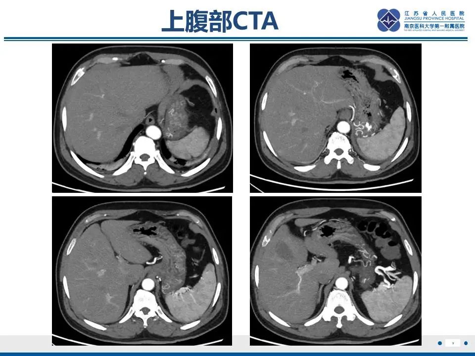 【PPT】胃恒径动脉综合征-4