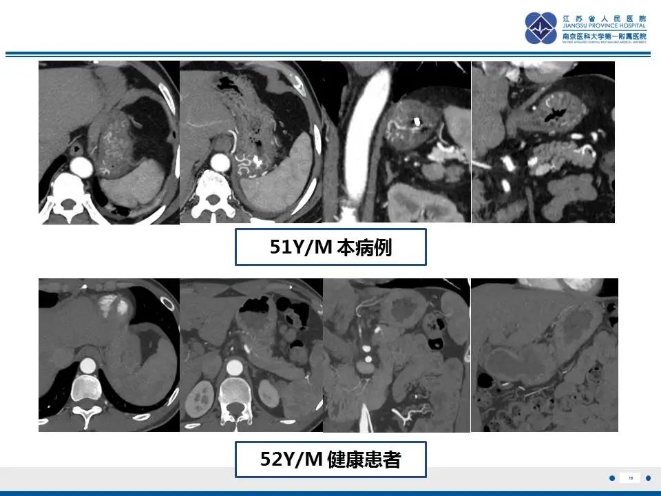 【PPT】胃恒径动脉综合征-17