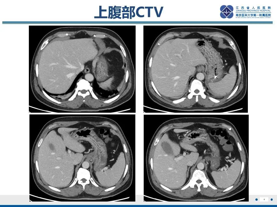 【PPT】胃恒径动脉综合征-6