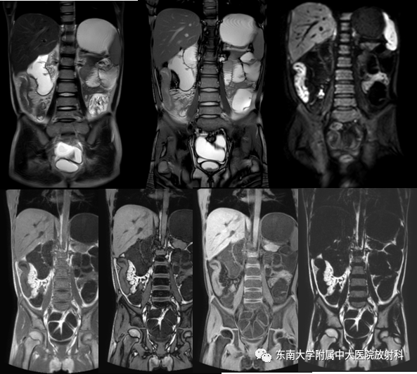 【PPT】克罗恩（Crohn’s）病-1