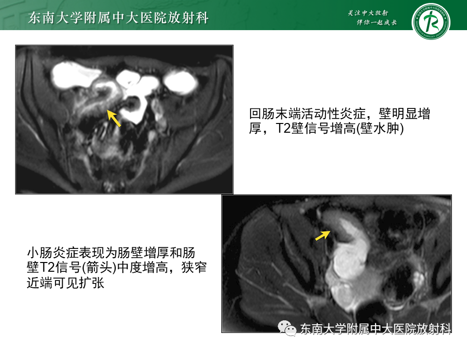 【PPT】克罗恩（Crohn’s）病-27