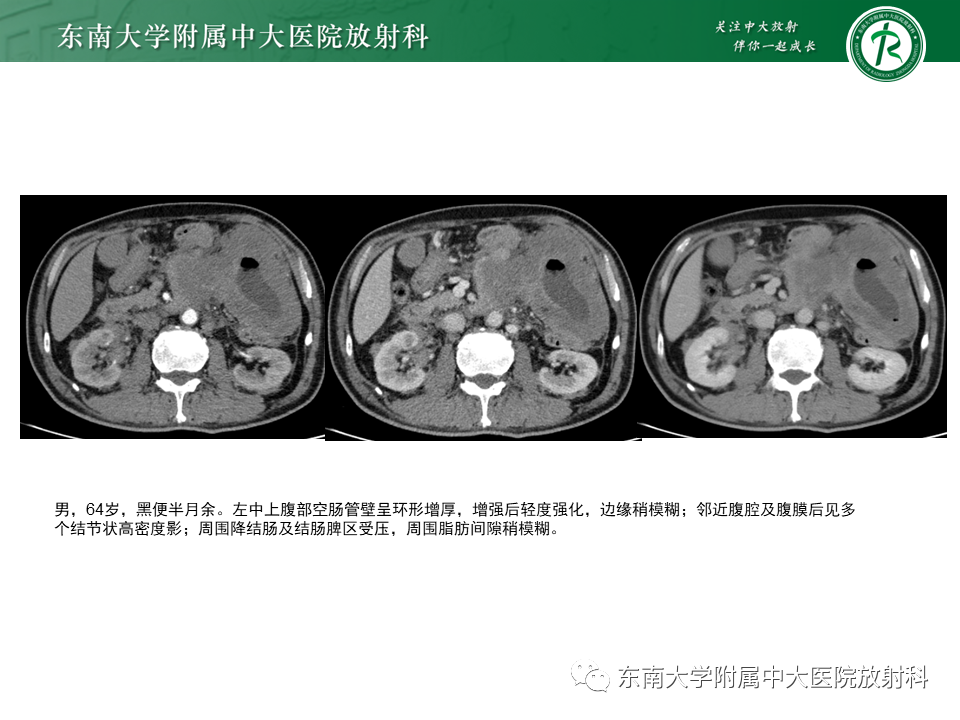 【PPT】克罗恩（Crohn’s）病-47