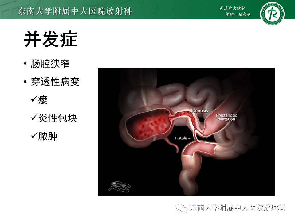 【PPT】克罗恩（Crohn’s）病-35