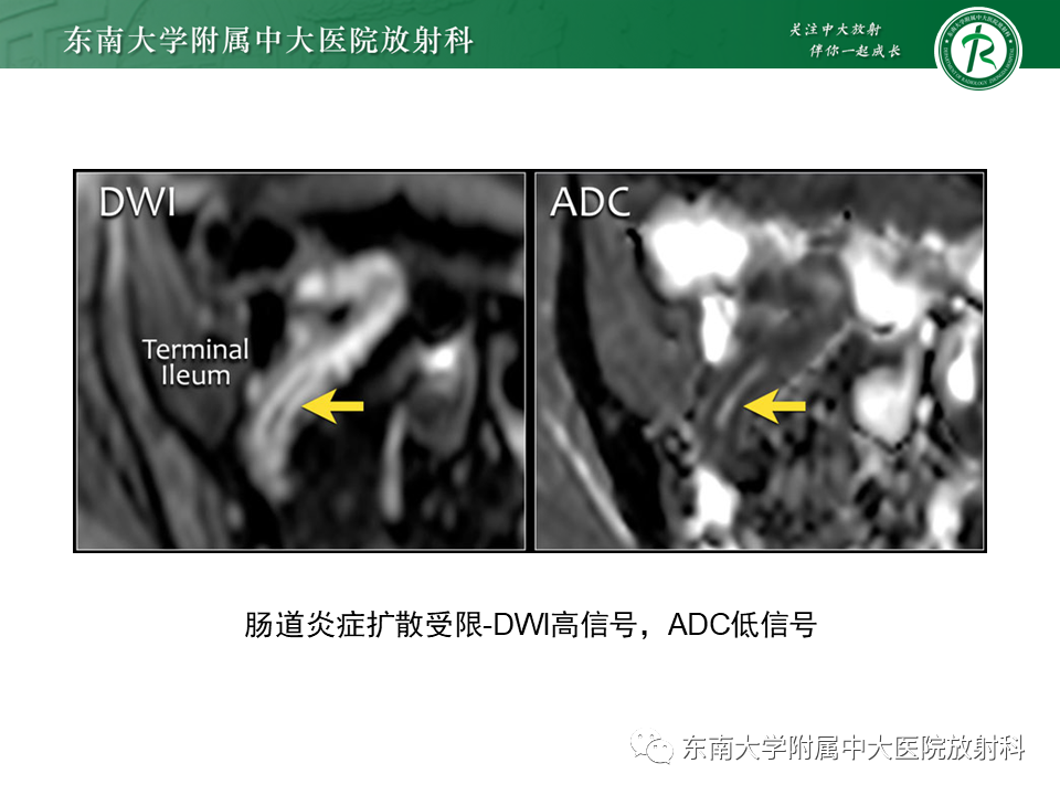 【PPT】克罗恩（Crohn’s）病-29