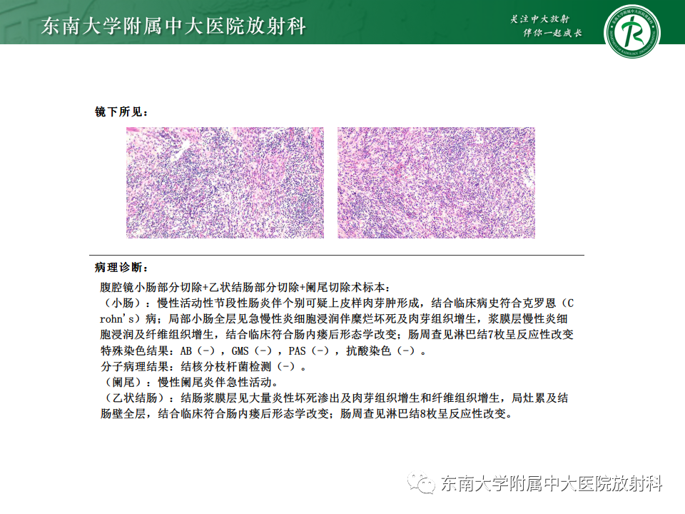 【PPT】克罗恩（Crohn’s）病-10
