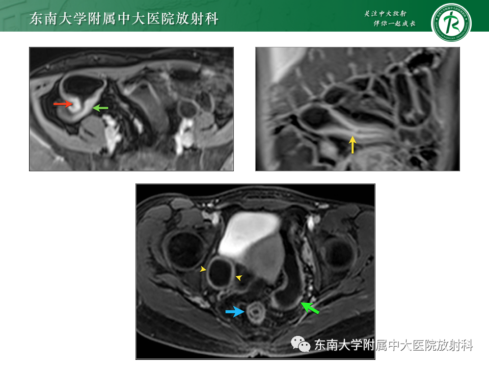 【PPT】克罗恩（Crohn’s）病-24