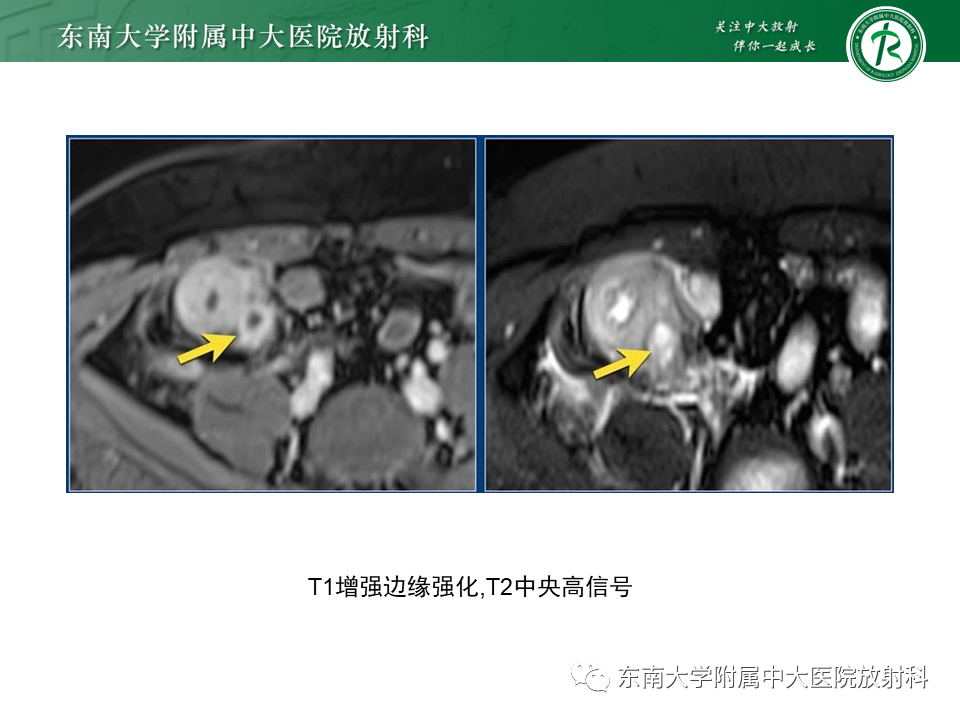 【PPT】克罗恩（Crohn’s）病-41