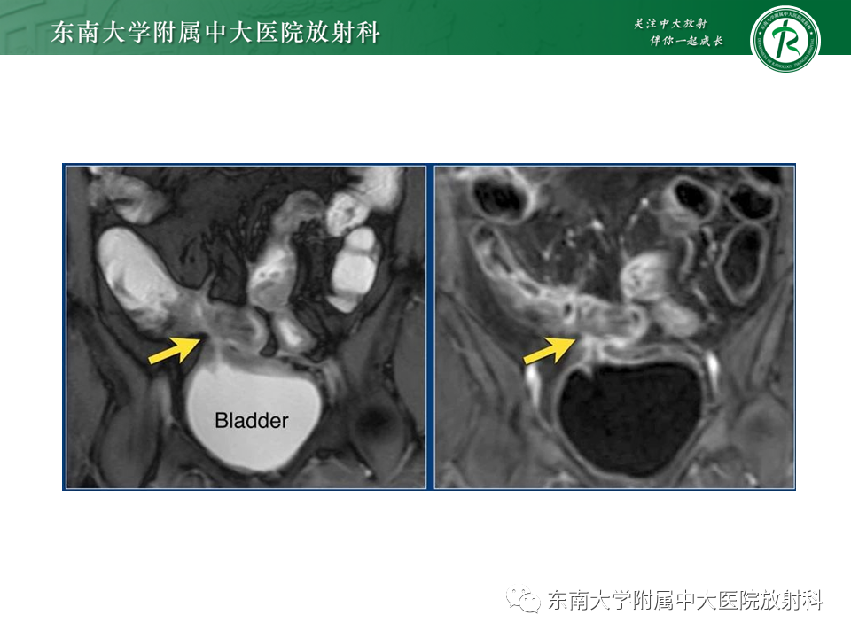 【PPT】克罗恩（Crohn’s）病-39