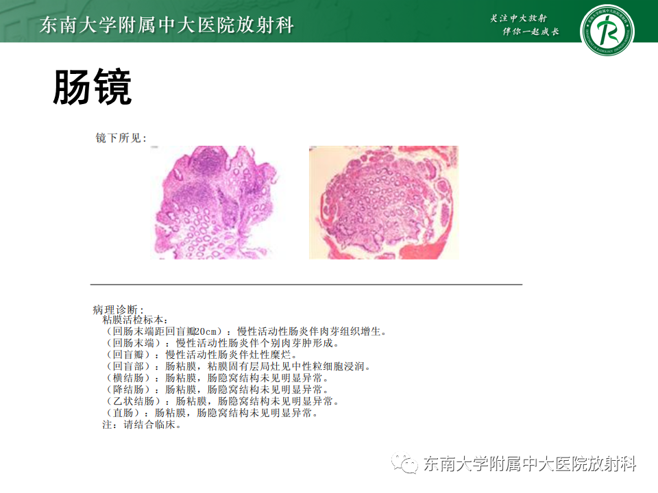 【PPT】克罗恩（Crohn’s）病-4