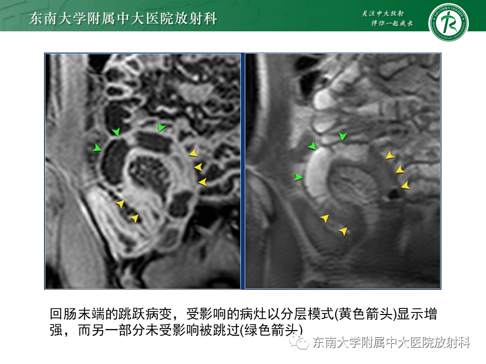 【PPT】克罗恩（Crohn’s）病-34