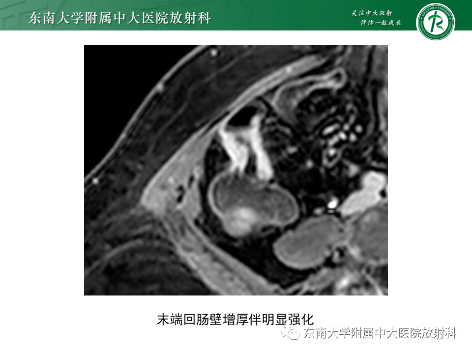 【PPT】克罗恩（Crohn’s）病-25