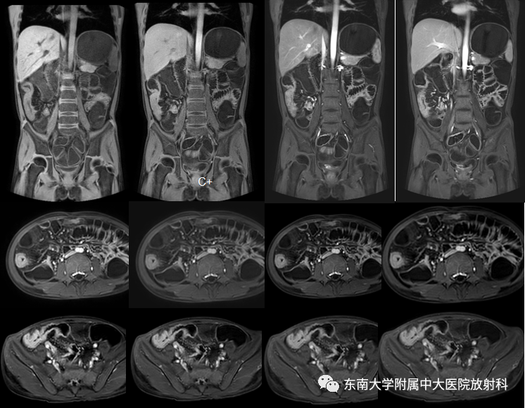 【PPT】克罗恩（Crohn’s）病-2