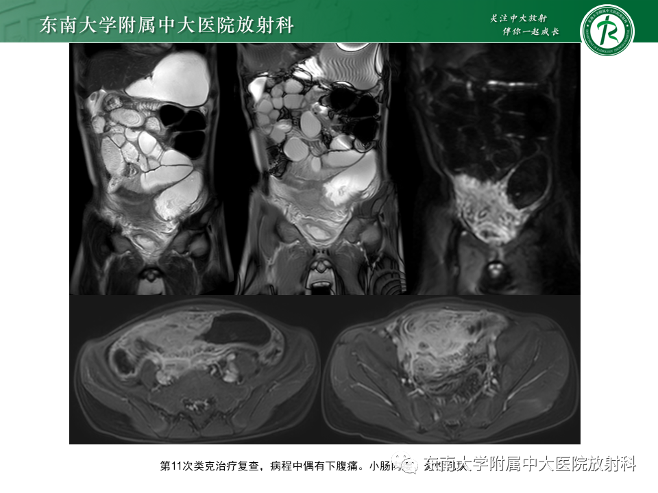 【PPT】克罗恩（Crohn’s）病-6