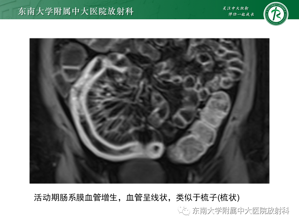 【PPT】克罗恩（Crohn’s）病-32