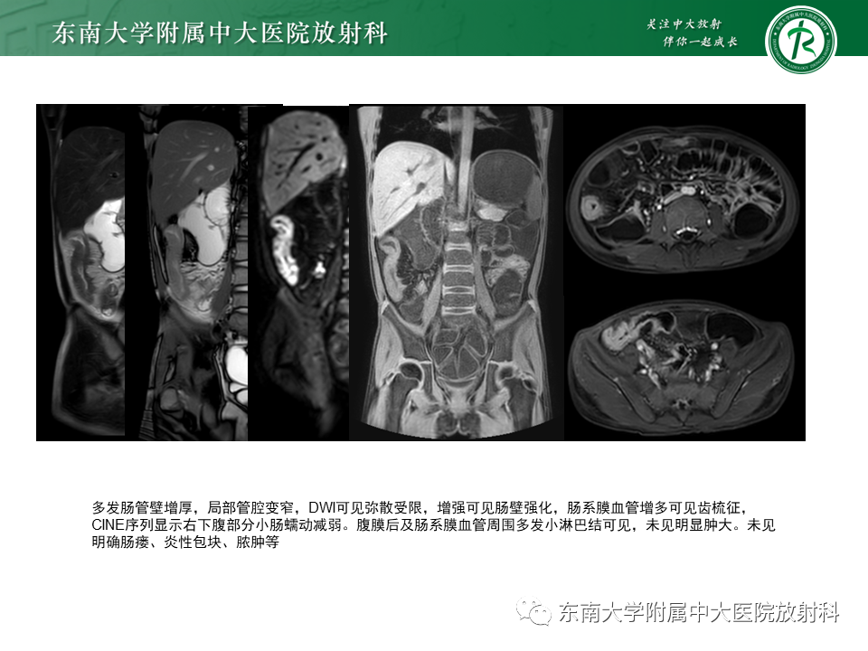 【PPT】克罗恩（Crohn’s）病-3