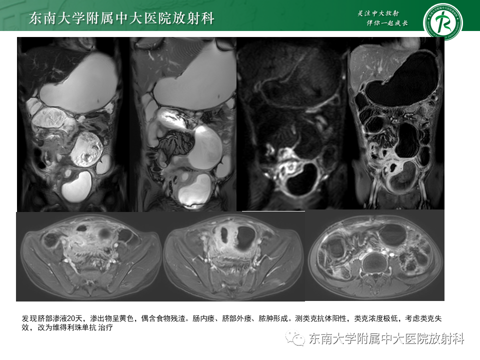 【PPT】克罗恩（Crohn’s）病-7