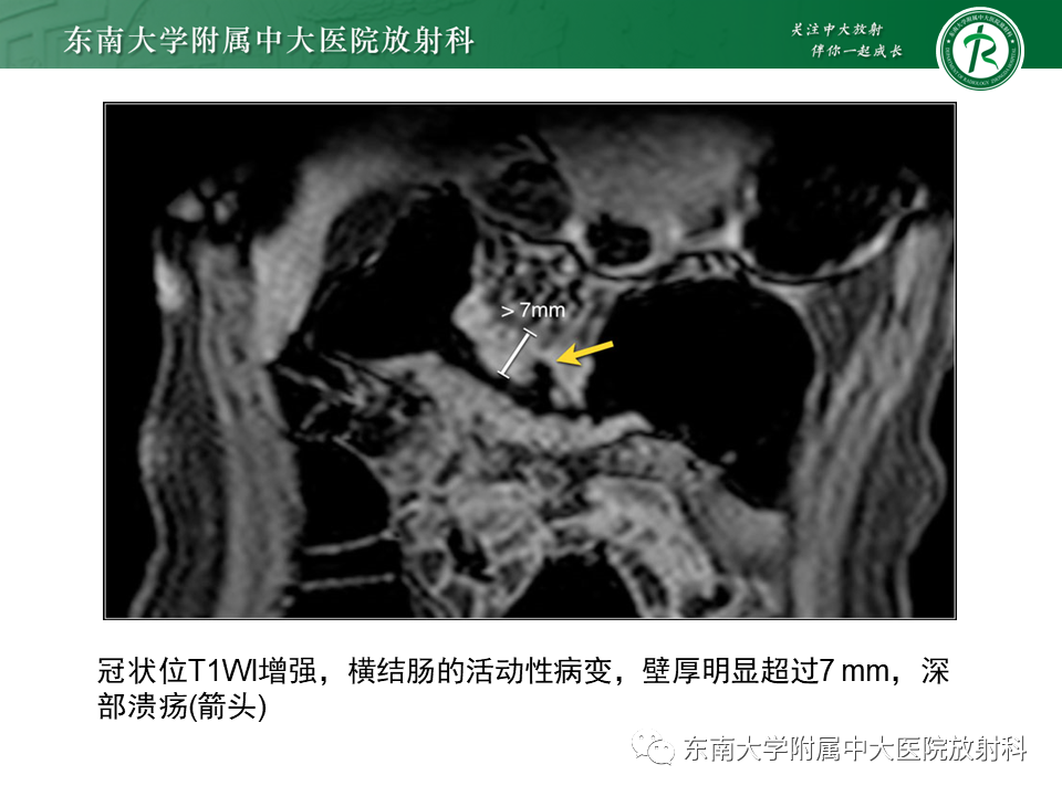 【PPT】克罗恩（Crohn’s）病-22