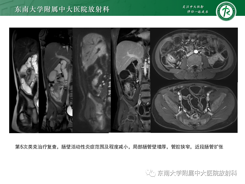【PPT】克罗恩（Crohn’s）病-5