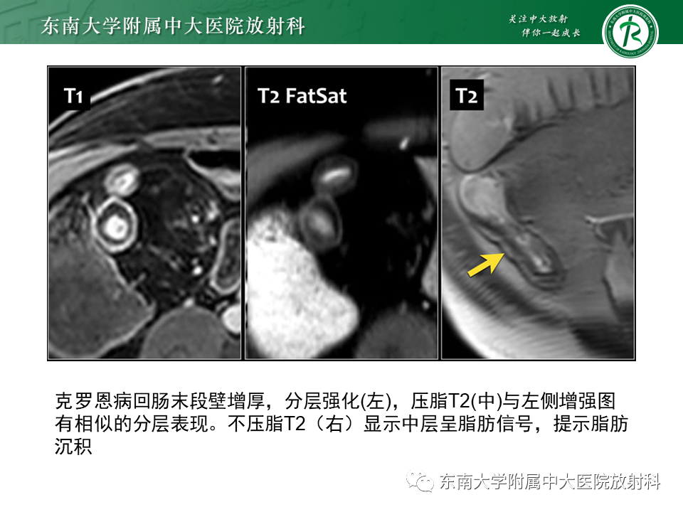 【PPT】克罗恩（Crohn’s）病-28