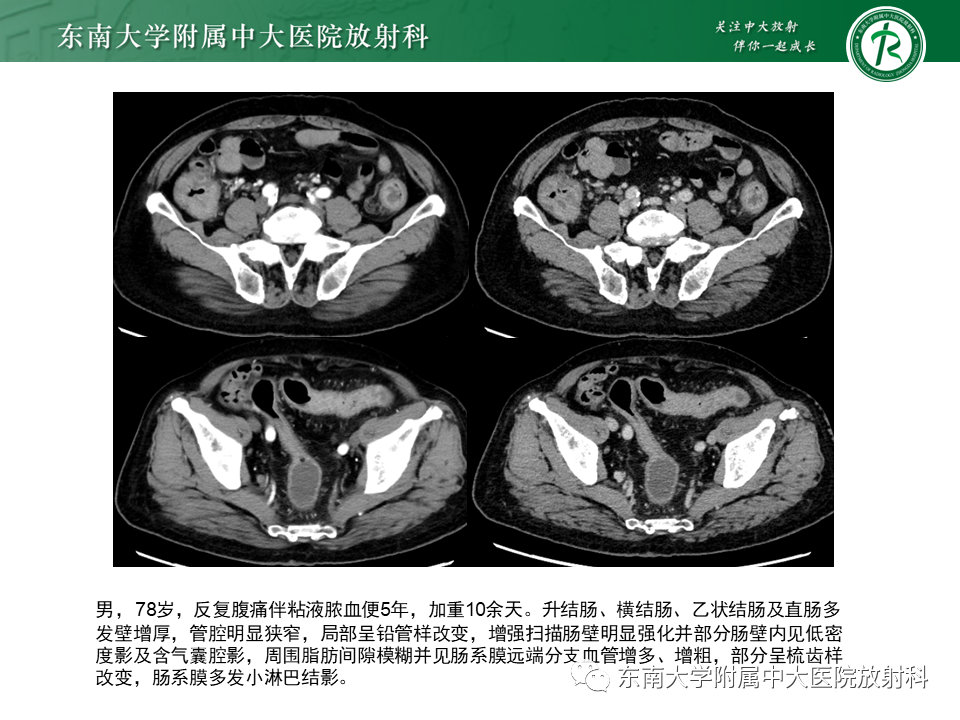 【PPT】克罗恩（Crohn’s）病-51