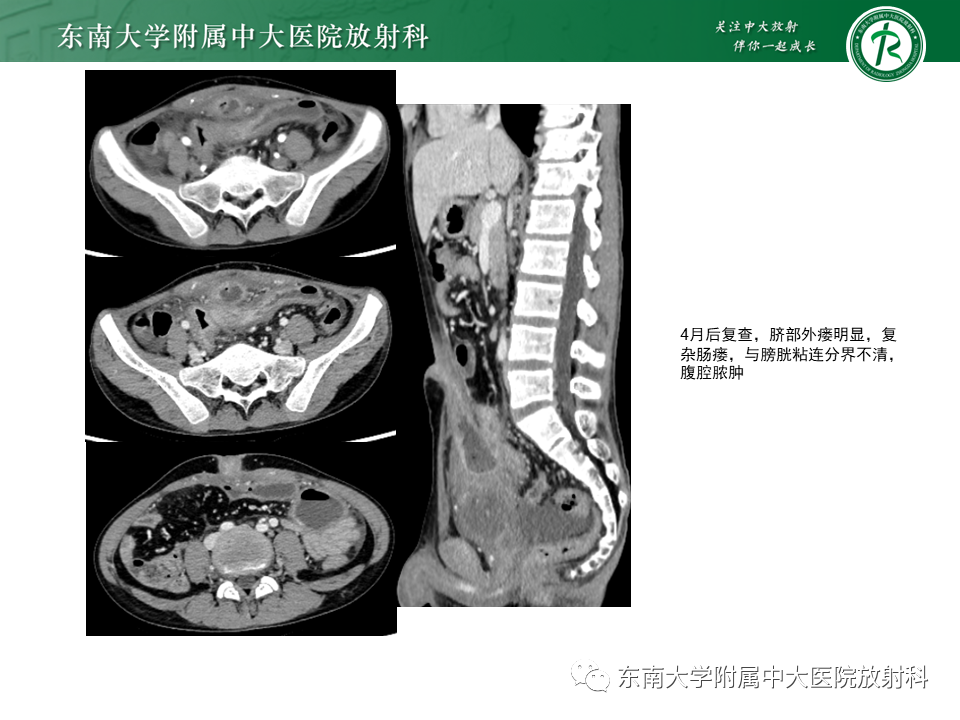 【PPT】克罗恩（Crohn’s）病-8
