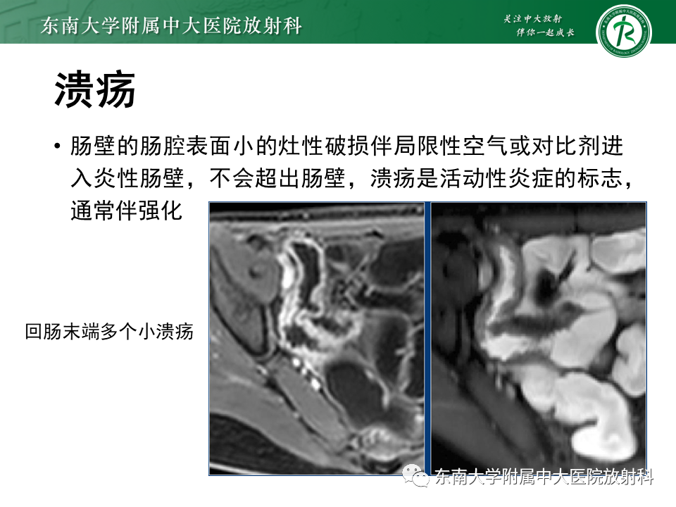 【PPT】克罗恩（Crohn’s）病-30
