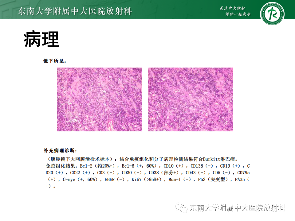 【PPT】克罗恩（Crohn’s）病-48