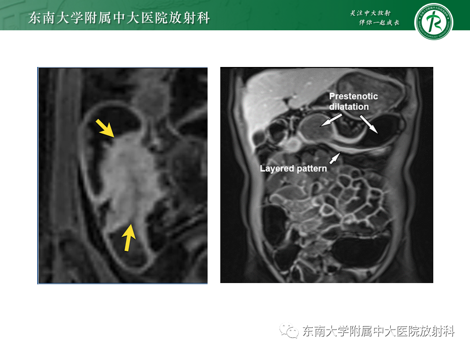 【PPT】克罗恩（Crohn’s）病-37