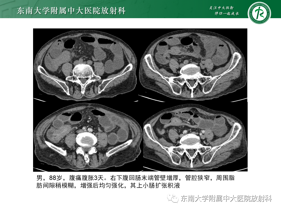 【PPT】克罗恩（Crohn’s）病-44