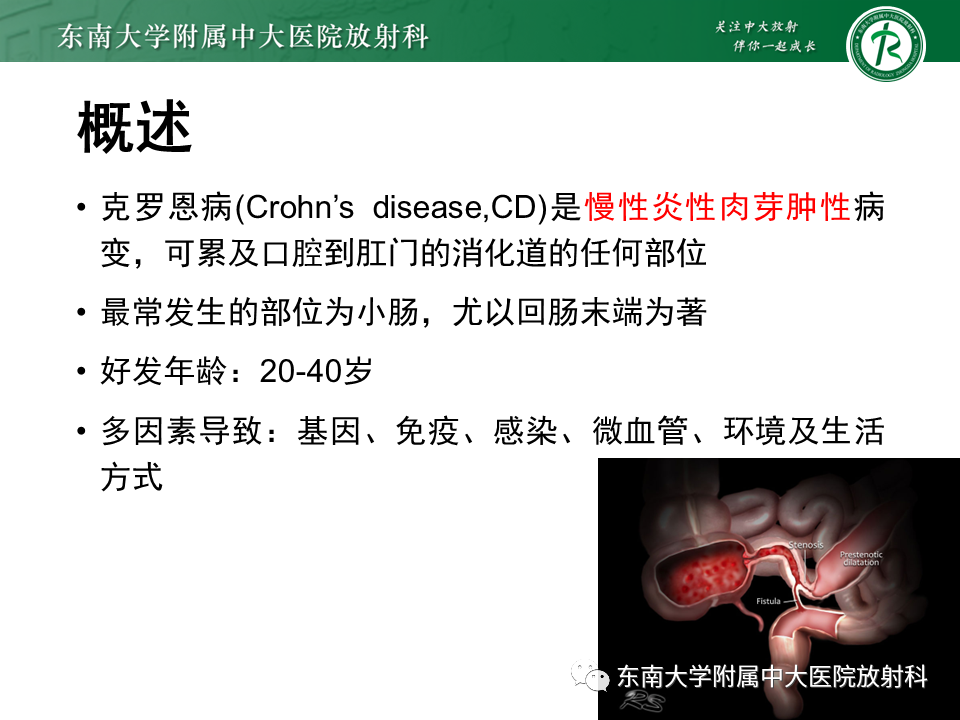 【PPT】克罗恩（Crohn’s）病-12