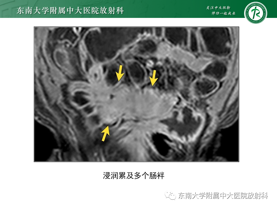 【PPT】克罗恩（Crohn’s）病-40