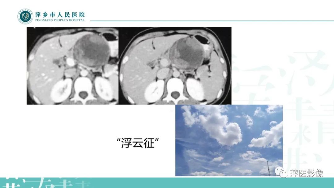 【PPT】胰腺实性假乳头状瘤-11