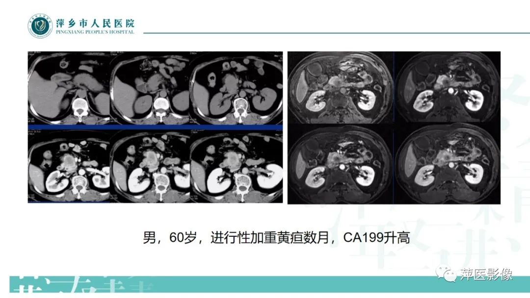【PPT】胰腺实性假乳头状瘤-16