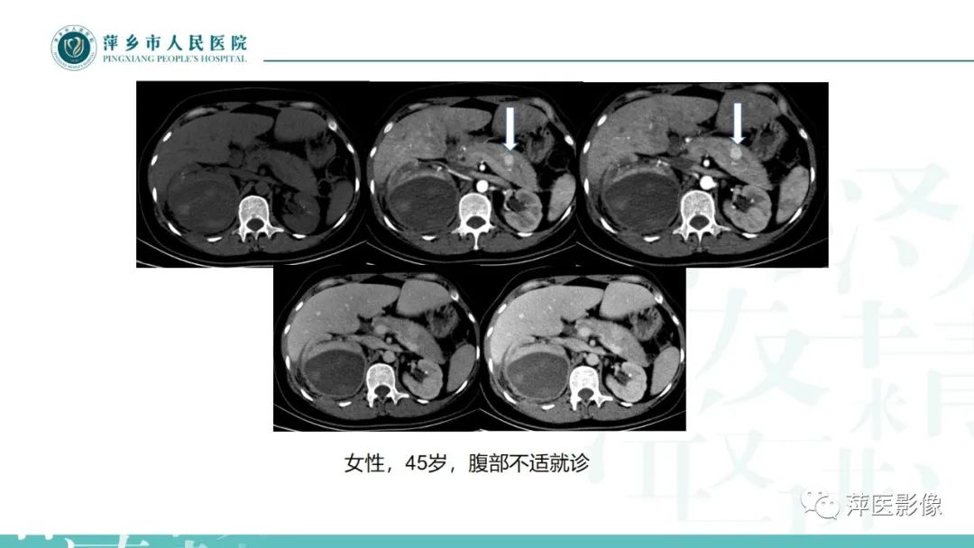 【PPT】胰腺实性假乳头状瘤-27