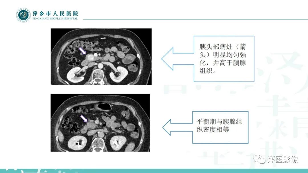 【PPT】胰腺实性假乳头状瘤-28