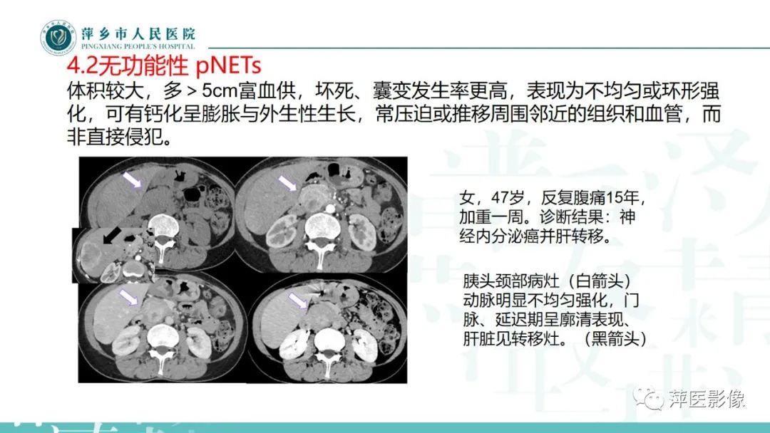 【PPT】胰腺实性假乳头状瘤-29