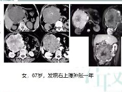 胰腺实性假乳头状瘤