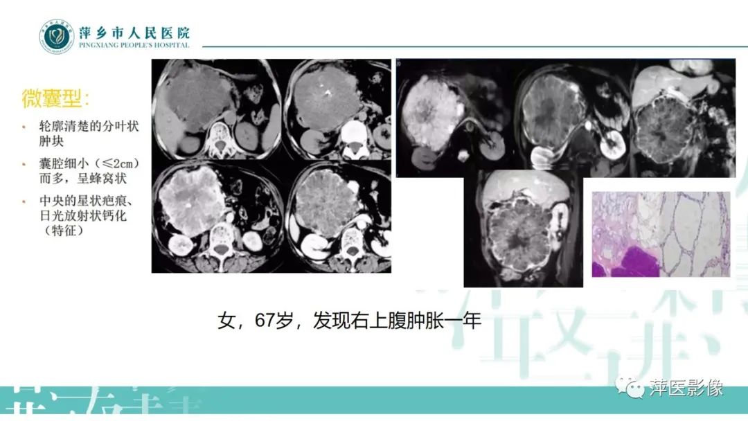 【PPT】胰腺实性假乳头状瘤-19