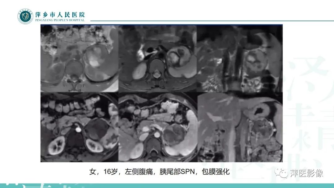 【PPT】胰腺实性假乳头状瘤-12