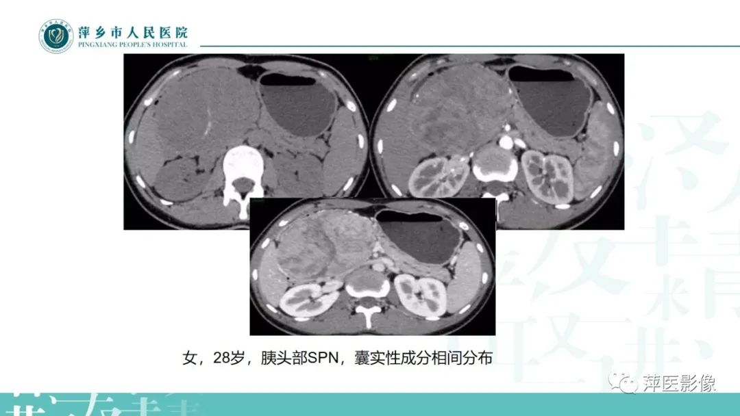 【PPT】胰腺实性假乳头状瘤-10