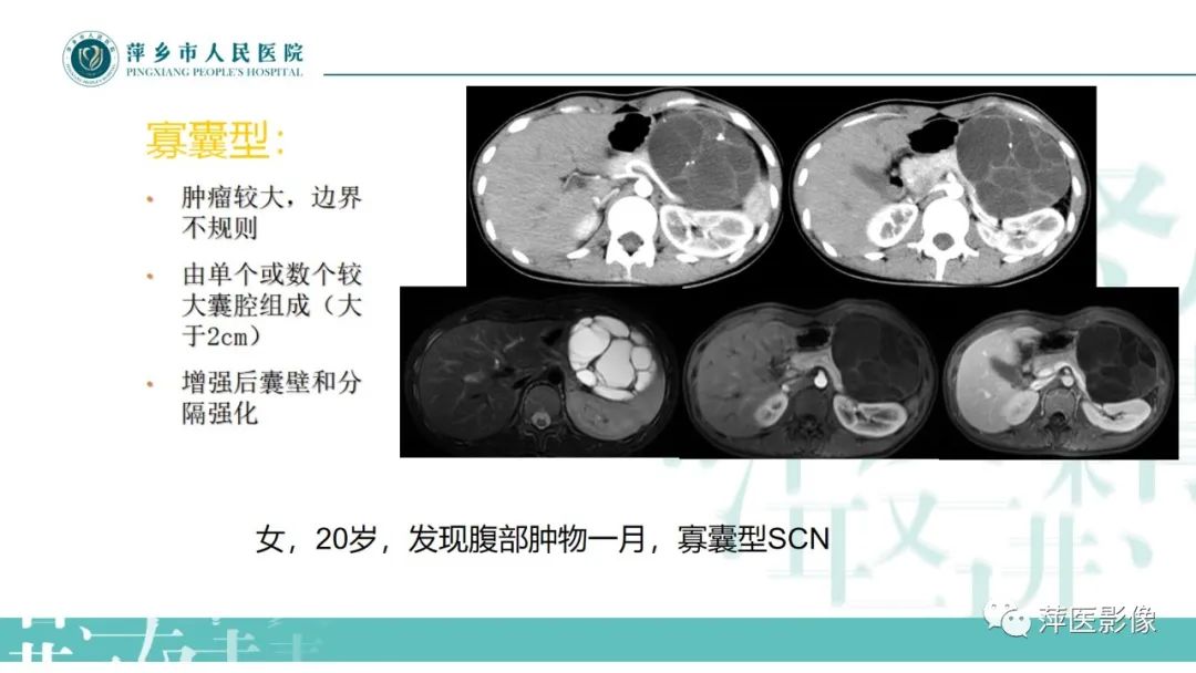 【PPT】胰腺实性假乳头状瘤-20