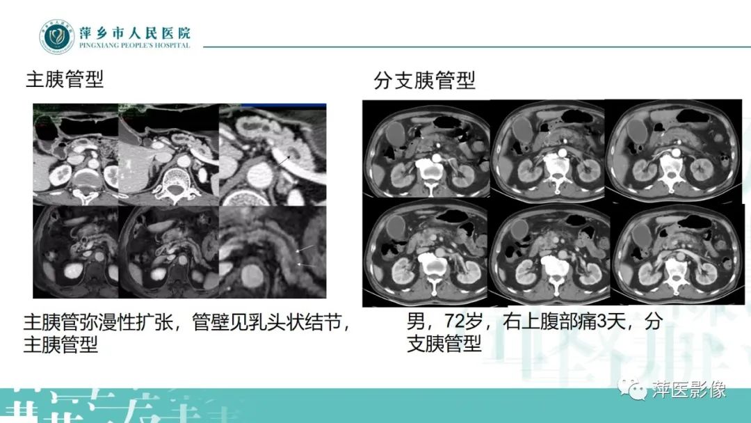 【PPT】胰腺实性假乳头状瘤-24
