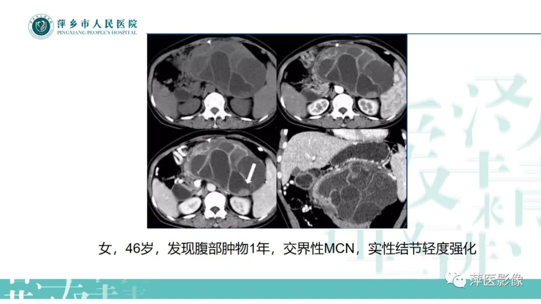 【PPT】胰腺实性假乳头状瘤-22
