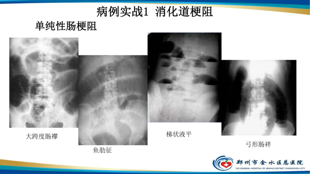 【PPT】常见急腹症的影像学诊断-12