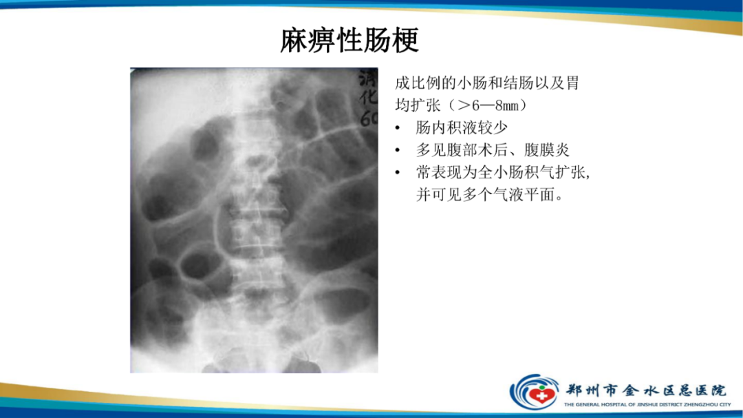 【PPT】常见急腹症的影像学诊断-14