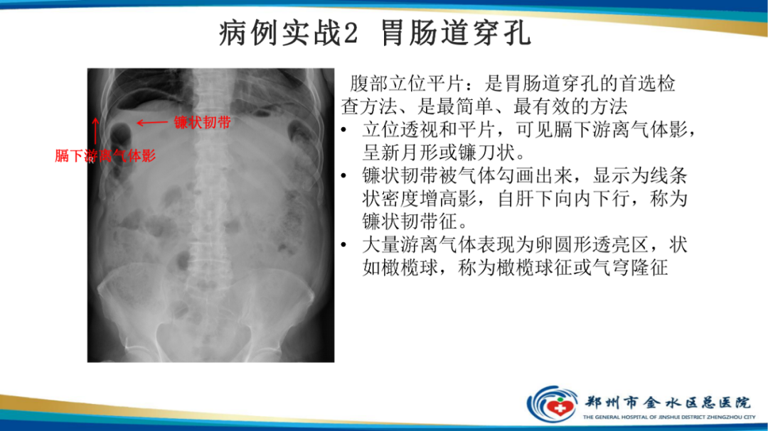 【PPT】常见急腹症的影像学诊断-16